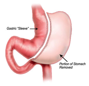 Sleeve gastrectomy (single technique) 