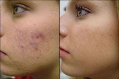 acne treatment