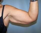 brachioplasty surgery India low cost advantages