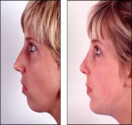 chin augmentation India low cost benefits