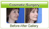 Tour2india4Health - Cosmetic Surgery Before After Gallery