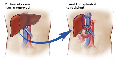 liver transplant