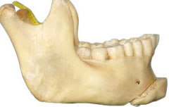 sliding Genioplasty india