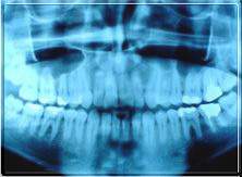 Dental_x-ray