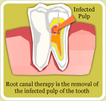 root-canal