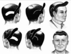 Flap surgery hair replacment india
