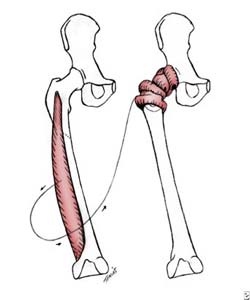 Girdlestone surgery hip india