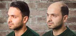 Hair Replacement Surgery in India