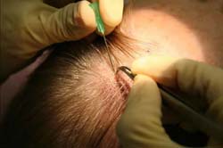 Hair Replacement surgery in India procedure