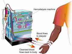 Kidney Dialysis India
