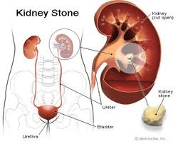 Kidney Stones