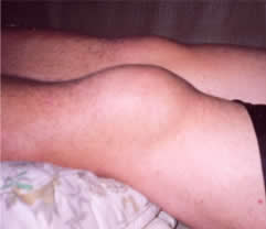Ligament Swelling