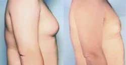 Male Breast Reduction Surgery India