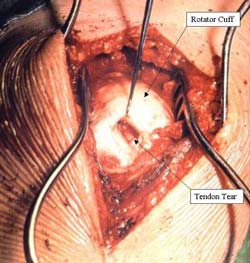 Open Surgical Rotator Cuff Repair India