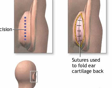 Otoplasty Surgery in India