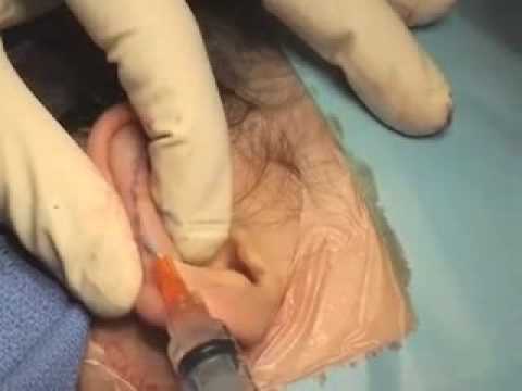 otoplasty surgery recovery India