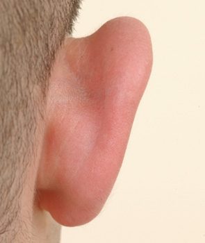otoplasty India