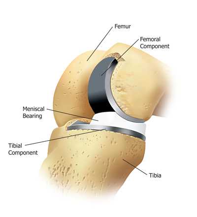 Partial Knee Replacement Surgery in India