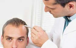 Preparing for Hair Replacement surgery in India