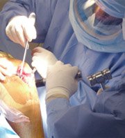 Procedure for Partial Knee Replacement Surgery India