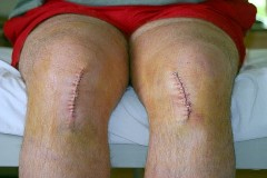 Recovery after Partial Knee Replacement Surgery India