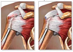 Rotator Cuff Tear Diagnosis