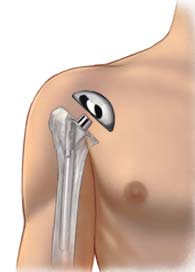 Shoulder Replacement Surgery India