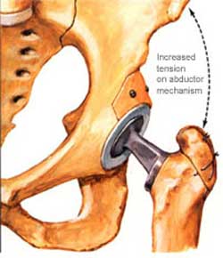Total Hip Replacement india