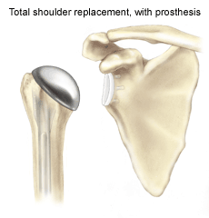 shoulder replacement surgery procedure