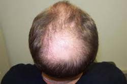 best candidate for Hair Replacement surgery