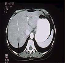 Cancer Chemotherapy India