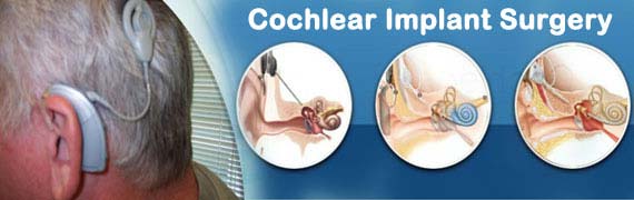 Cochlear Implant Surgery India