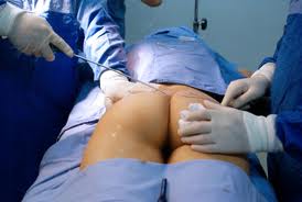 cost buttock augmentation surgery India