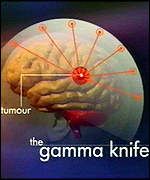 Gamma Knife Therapy India