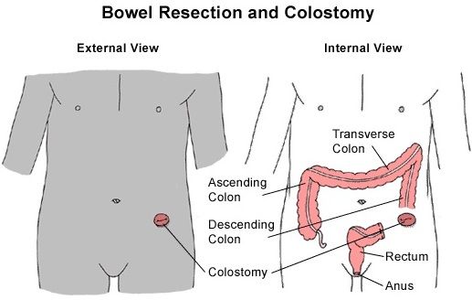 Gastric Intestinal Resection Surgery India