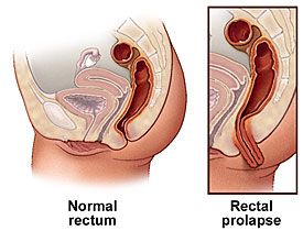Gastric Rectal Prolapse Surgery India