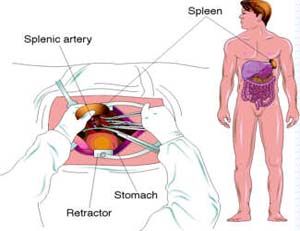 Gastric Splenectomy Surgery India