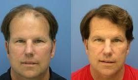 hair replacement surgery India low cost benefits experience