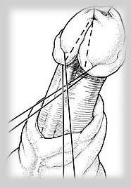 Hypospadias Surgery India
