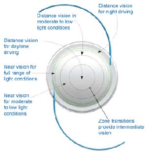 Intra Ocular Lens lmplant Surgery India