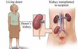 Kidney Transplant in India