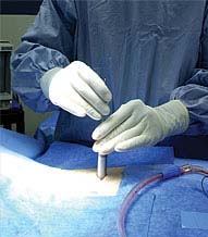 Laser Spine Surgery in India