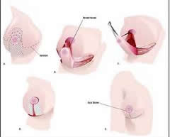 breast reduction surgery types
