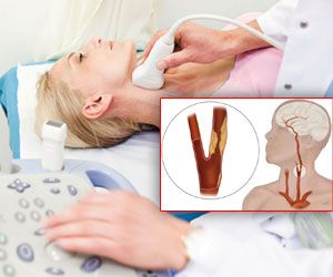 Neuro Carotid Endarterectomy Surgery India