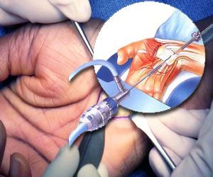 Neuro Carpal Tunnel Release Surgery in India