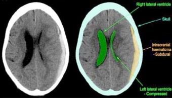 Neuro Chronic Sub-Dual Haematoma Surgery in India