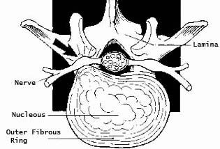 Neuro Percutaneous Endoscopic Lumbar Discectomy Surgery India