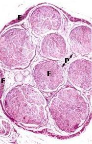 Neuro Spine Tumors Surgery India