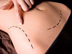 Tummy Tuck Surgery India Low Cost Benefits