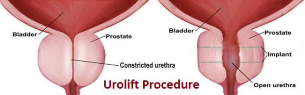 Urolift Treatment in India